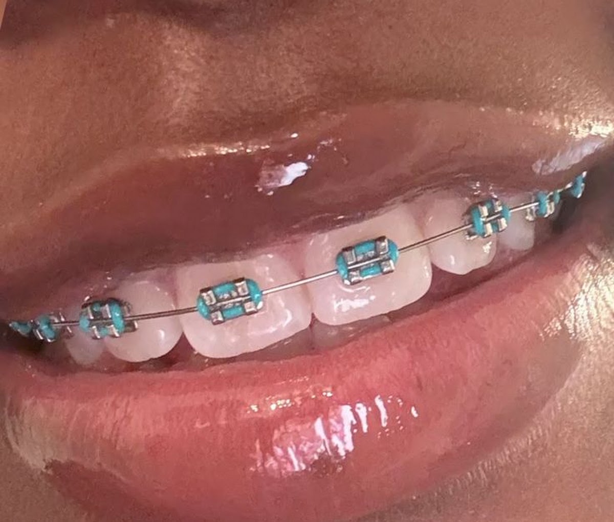 Orthodontic braces